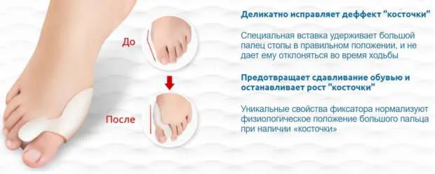 Достоинства фиксатора