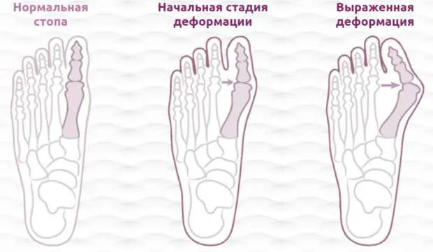 Вальгусная деформация