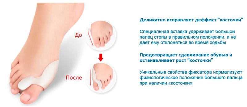 Как работает фиксатор шишки на ноге