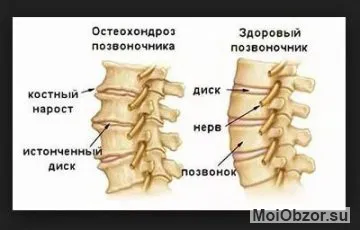 Остеохондроз