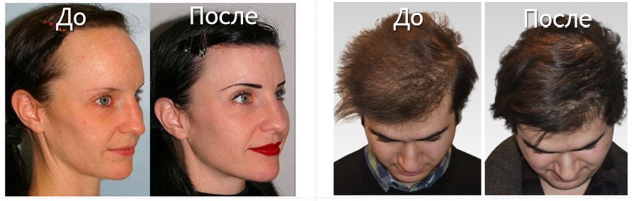 эффект спрея от облысения и выпадения волос YUDA Pilatory